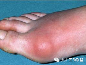 尿酸高或有痛风史的朋友请收藏