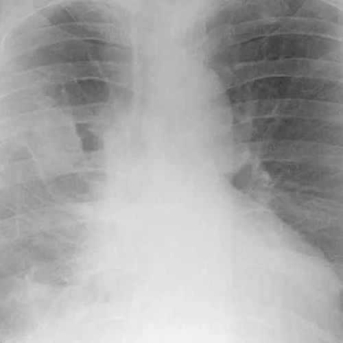 白肺和原始毒株有关？官方回应